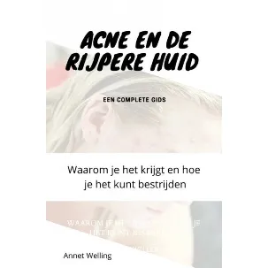 Afbeelding van Acne bij volwassenen